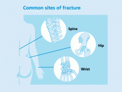 Fracture Sites